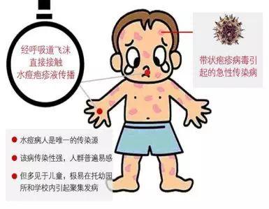 【卫生保健】做好防控 健康无痘——弥陀桂花园幼儿园预防水痘温馨提示