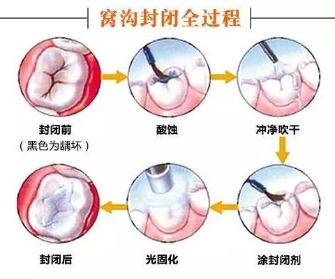 儿童口腔“窝沟封闭”，爸爸妈妈一定要注意了