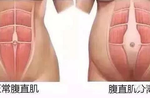 产后修复的重要性以及建议