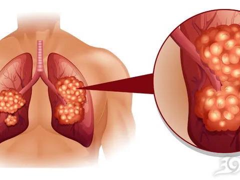 ​肺癌一查就是晚期？其实双腿早早给了暗示，只是很多人错过了