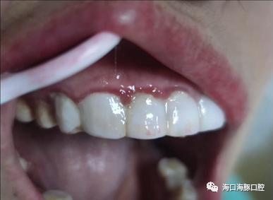 美容院的美牙项目，真的靠谱吗？—中医院四楼口腔科