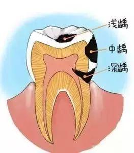 补牙，为什么不可以一次性完成？—中医院四楼口腔科