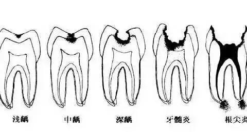 从'浅龋'到'拔牙'，看看牙齿是怎么下岗的？—中医院四楼口腔科