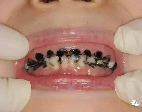 你还敢说小孩子刷什么牙吗？—中医院四楼口腔科