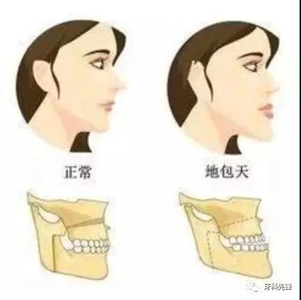 “地包天”到底有什么危害？什么年龄段治疗比较好？—中医院四楼口腔科