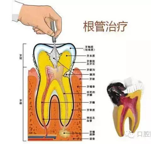 根管治疗不仅仅是抽牙神经