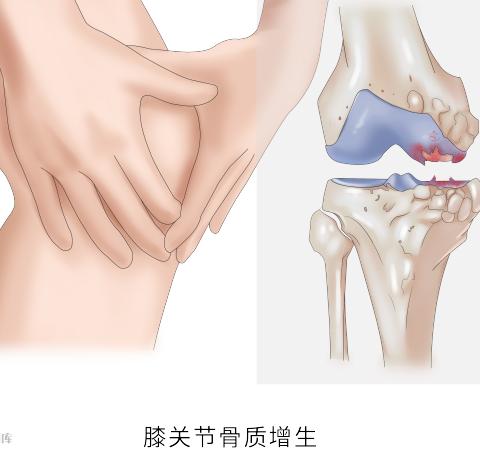 脚后跟疼，是长骨刺了吗？5 个方法缓解疼痛