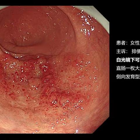 内镜医生眼中的肠息肉