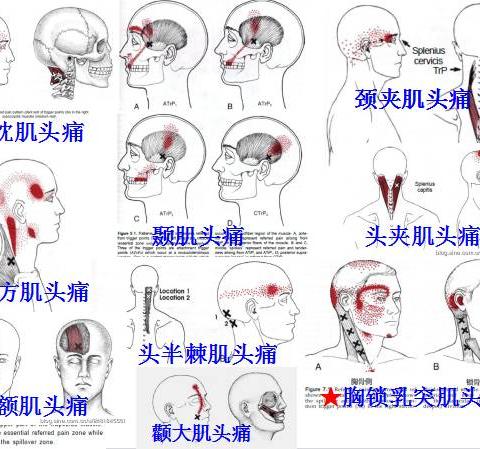 全身激痛点手册(值得收藏)