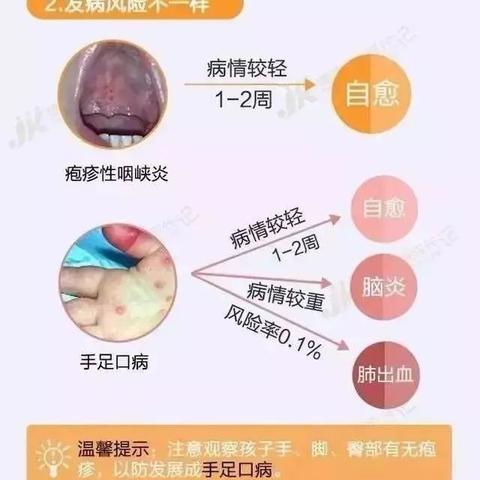 秋季疱疹性咽峡炎大爆发！比手足口病还厉害！