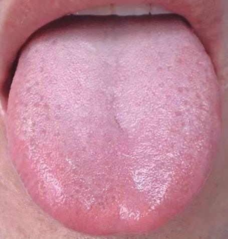 舌头中间有裂纹，或者边缘有齿痕等，是『大病征兆』？？？