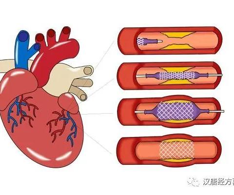 心脏支架！让生命进入倒计时，放上支架，不是麻烦结束了，而是麻烦才开始了！