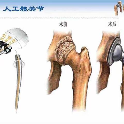 髋关节置换术术后功能锻炼