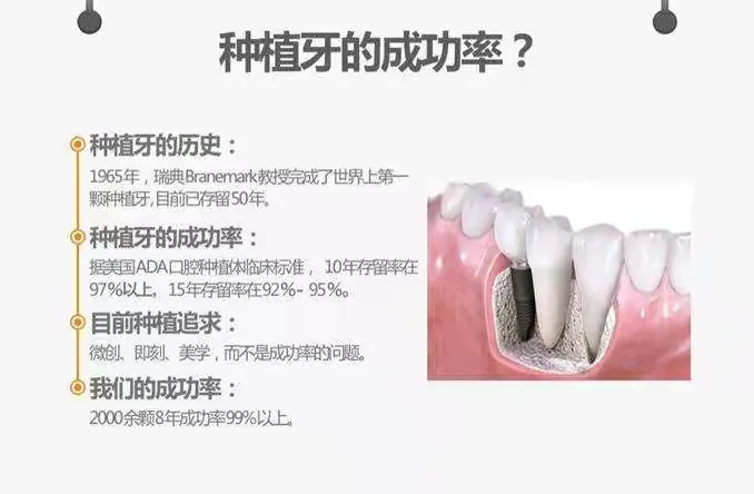 种植牙--让您找回真牙的感觉
