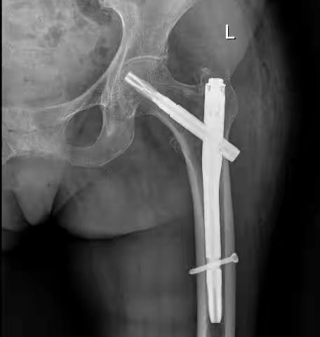 百岁老人在我科成功实施髋部骨折内固定术
