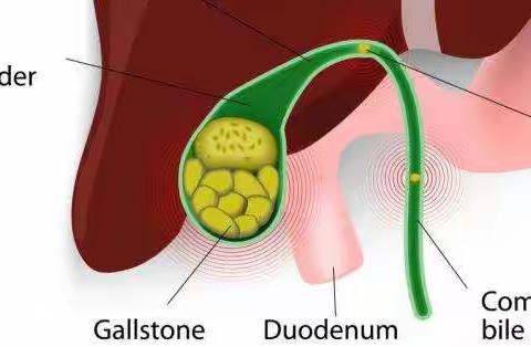 普外资讯：胆囊结石患者，这些您都知道吗？