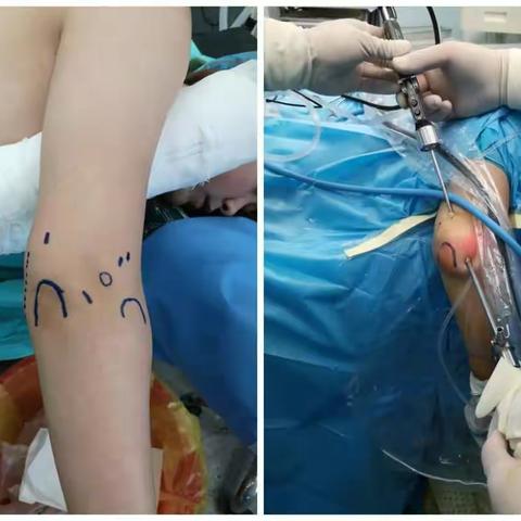肘关节镜，给肘关节病人多一种选择