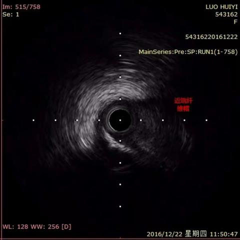 IVUS-Entrypoint病例1-实时指导