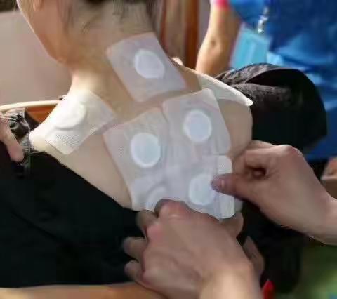 穴位贴敷技术的介绍与应用范围