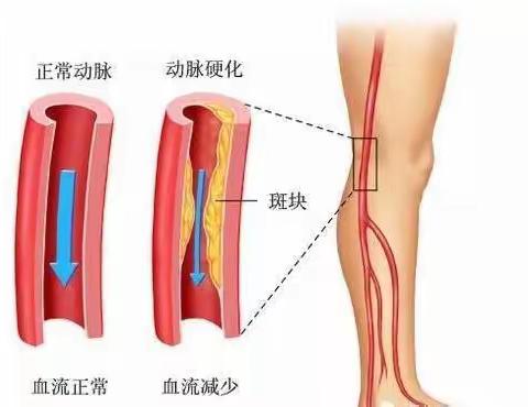 下肢动脉硬化闭塞症健康宣教