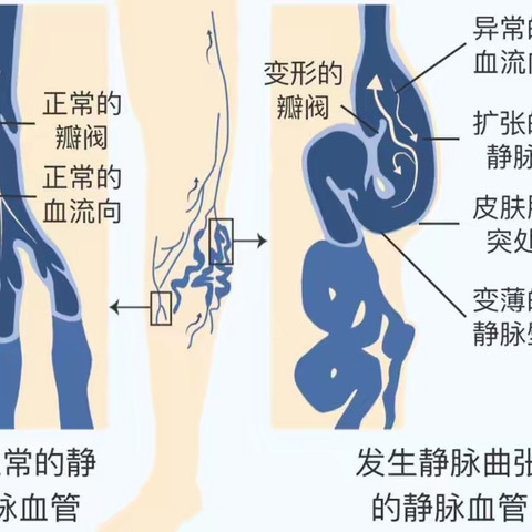 下肢静脉曲张健康宣教