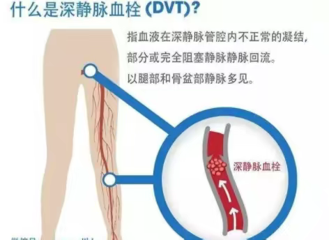 下肢深静脉血栓健康宣教