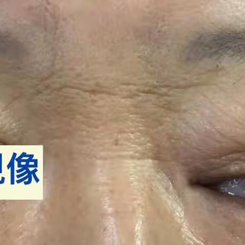 吴彦桥手术案例分享-巨大额窦骨瘤的手术体会