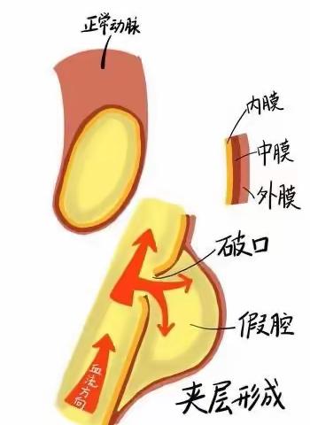 极为凶险的主动脉夹层，血压高的人要注意!