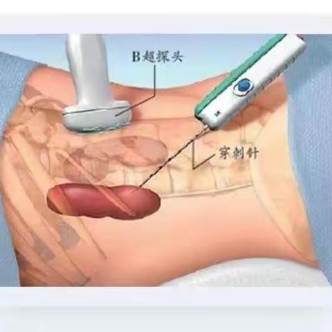 带您了解“肾活检”超声新业务