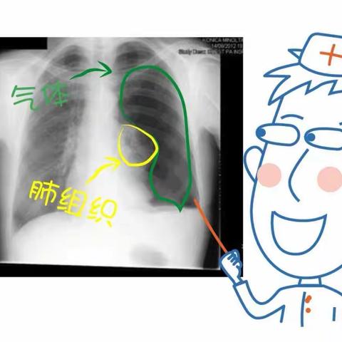 【安阳六院】“肺被气炸了”可不是玩笑话，有图有真相👇