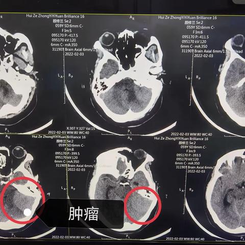 会泽中医院脑外科近期开展“脑肿瘤切除”病例分享