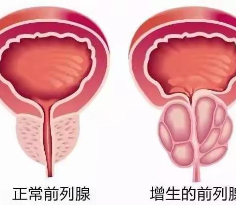 日常生活中男性如何保养前列腺？