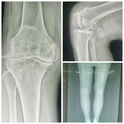 一例重度膝关节骨性关节炎行TKA治疗汇报