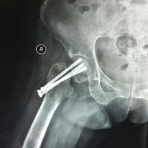 股骨颈骨折术后股骨头坏死行全髋关节置换术