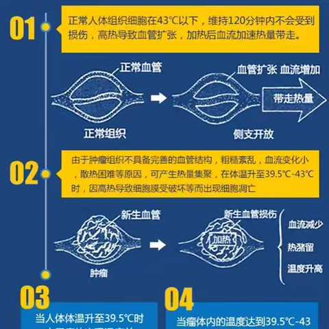 恶性肿瘤新武器——微波肿瘤热疗