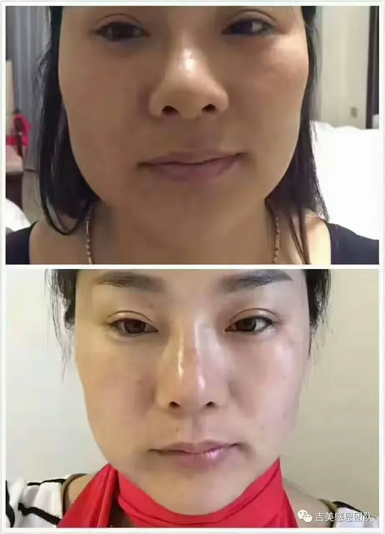 吉美v脸,一款打破护肤美容行业一个颠覆性的核武器,真正践行科技回归