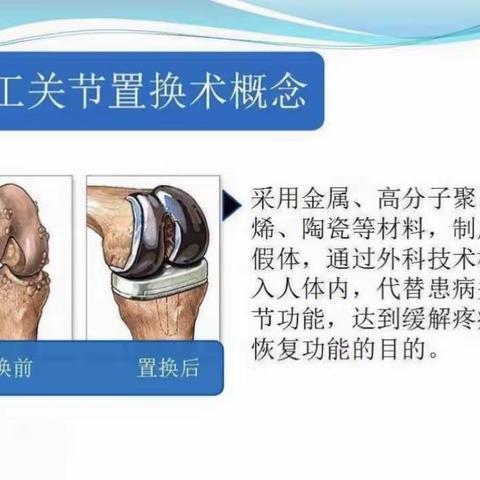 人工膝关节表面置换术