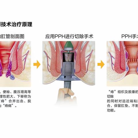 时隔20年PPH技术终于落户我院