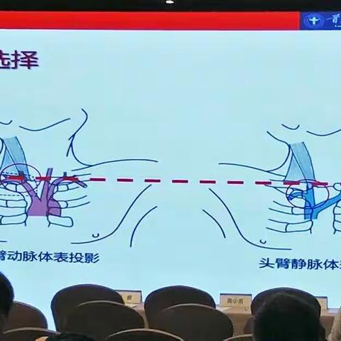 郁正亚：透析导管误入动脉的处理