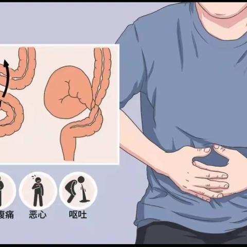 不同寻“肠”——肠梗阻的那些事儿