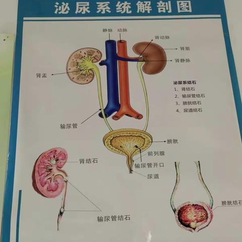 不同部位的结石