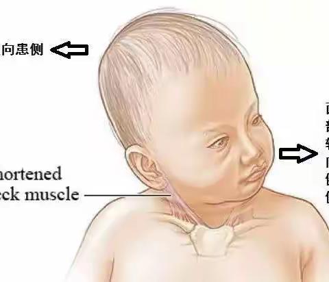 宝宝“歪脖”怎么办？