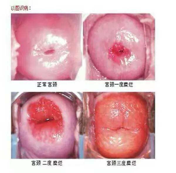 妇科问题，可怕的不是病，是缺少了解和有效预防、治疗的手段