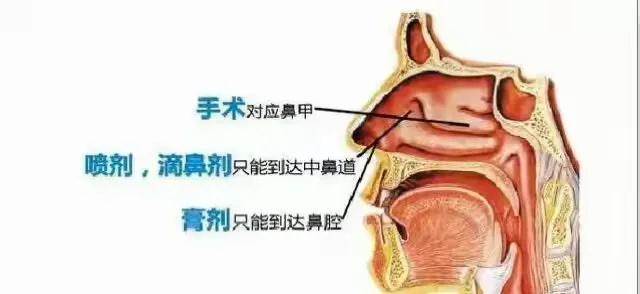 鼻炎的精油调理方法