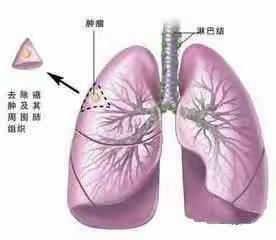 聊城市第三人民医院CT、磁共振室提醒您：健康体检您做低剂量胸部CT检查了吗？宝石能谱CT早期肺癌低剂量筛查