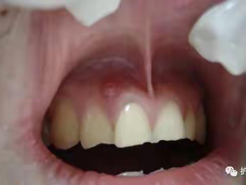 牙龈上长脓包，挤掉后还反复长出，怎么回事？