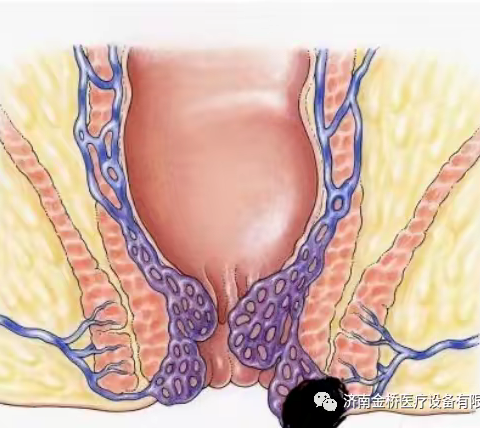 健康科普之四：血栓性外痔