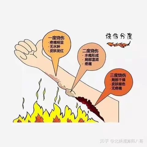 烧伤的急救措施小科普——巩义市中医院