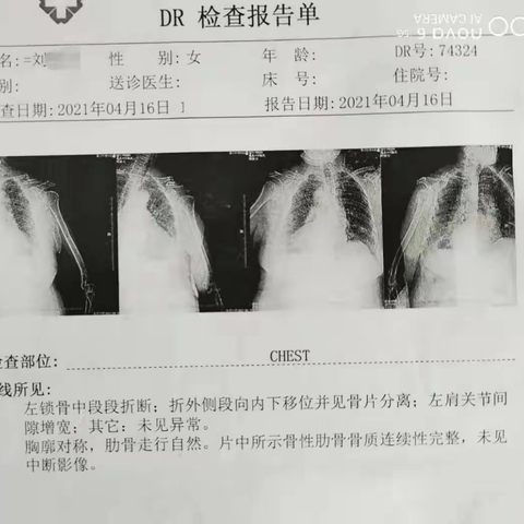 喜讯！我院成功开展左锁骨骨折切开复位内固定术