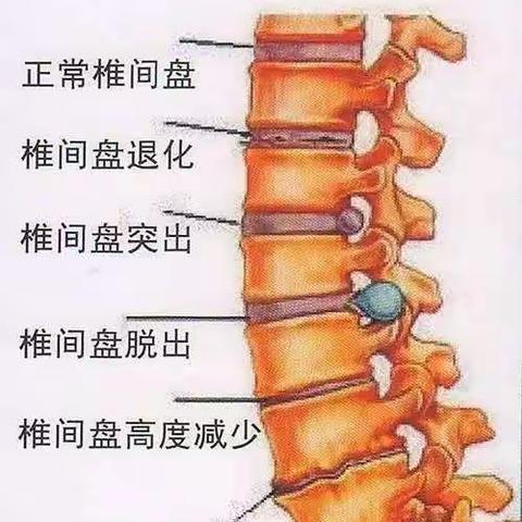 推拿对于腰椎间盘突出的效果